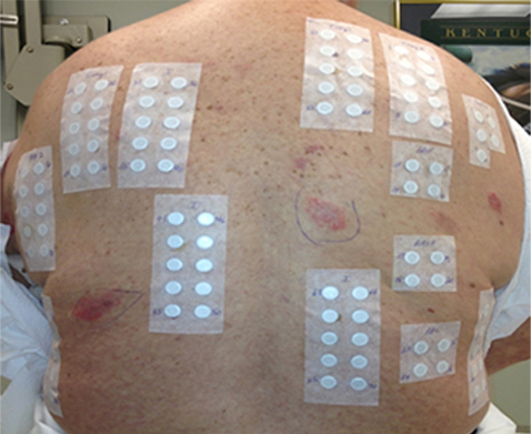 Example of Patch Test Placement