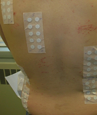 2nd Example of Patch Test Placement