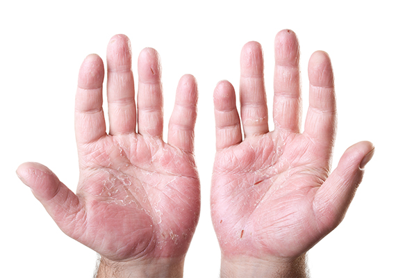 Allergic Contact Dermatitis